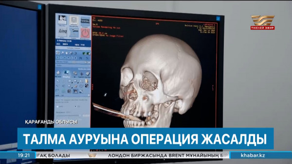 Эпилепсиямен ауыратын адамның миына күрделі операция жасалды. Өңір жаңалықтары