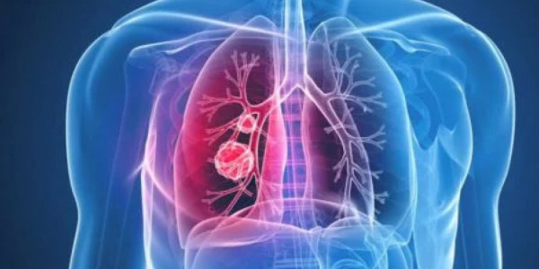 Пневмония коронавирус статистикасында есепке алынбайды