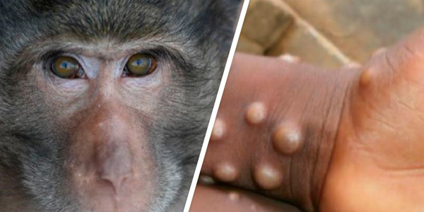 Минздрав призвал казахстанцев воздержаться от поездок в Западную Африку из-за вспышки оспы обезьян