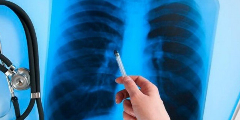 В шесть раз уменьшилась смертность и заболеваемость туберкулезом в Казахстане