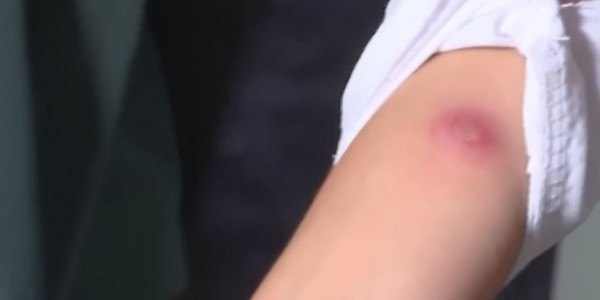 Ақтөбеде 42 оқушыға мантудың орнына БЦЖ вакциансының егілуіне байланысты қылмыстық іс қозғалды