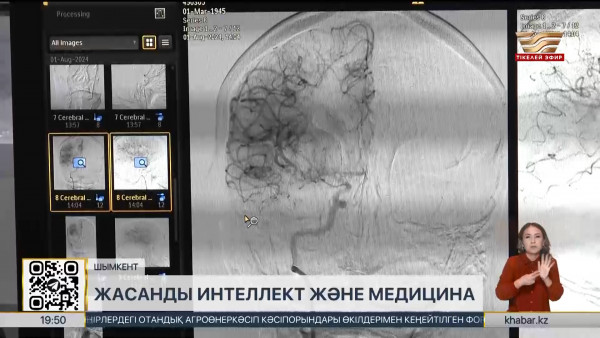 Шымкентте дәрігерлер инсультті ЖИ көмегімен анықтайды